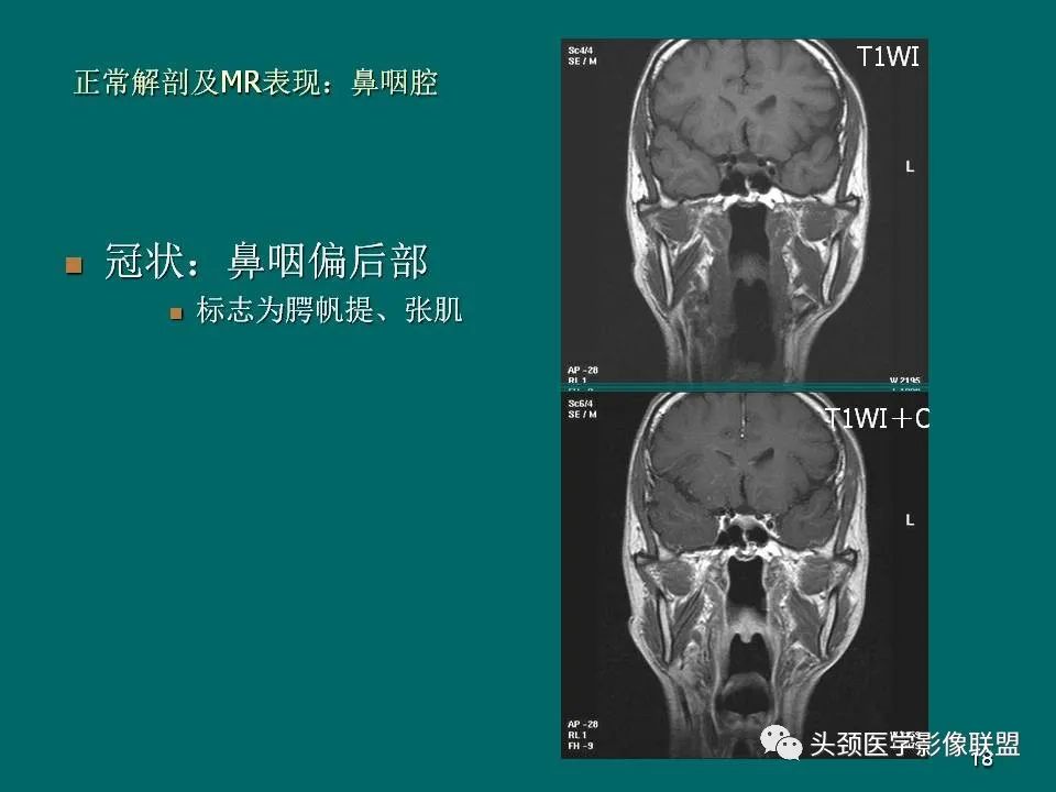 影像PPT - 【PPT】鼻咽癌的MRI诊断-18