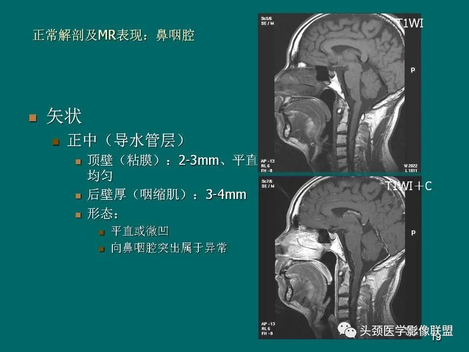 影像PPT - 【PPT】鼻咽癌的MRI诊断-19