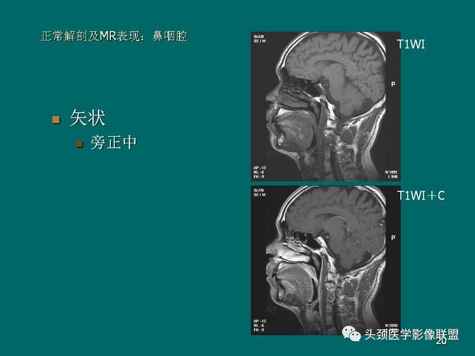 影像PPT - 【PPT】鼻咽癌的MRI诊断-20