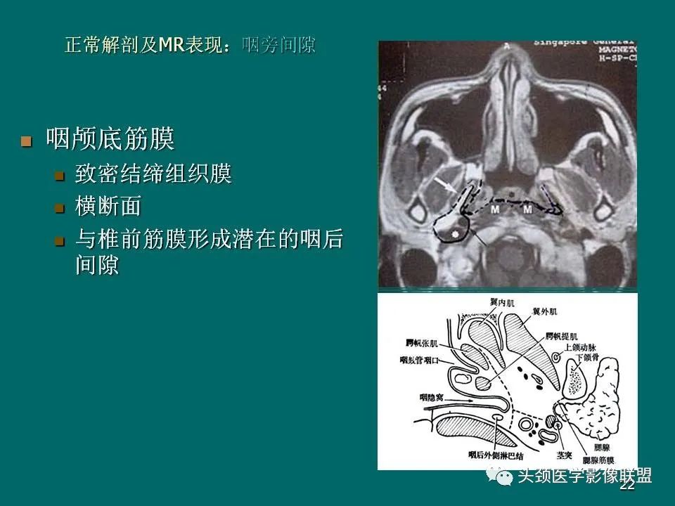 影像PPT - 【PPT】鼻咽癌的MRI诊断-22