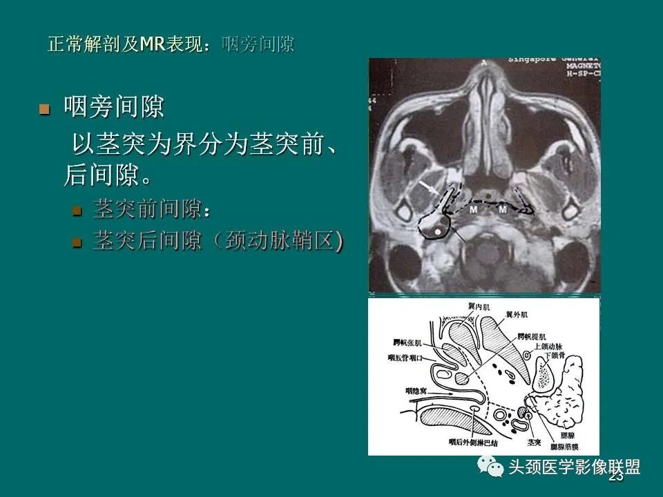 影像PPT - 【PPT】鼻咽癌的MRI诊断-23