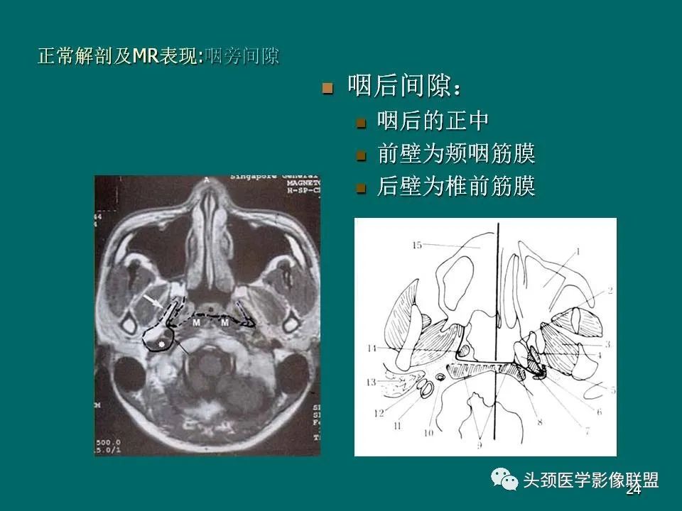 影像PPT - 【PPT】鼻咽癌的MRI诊断-24