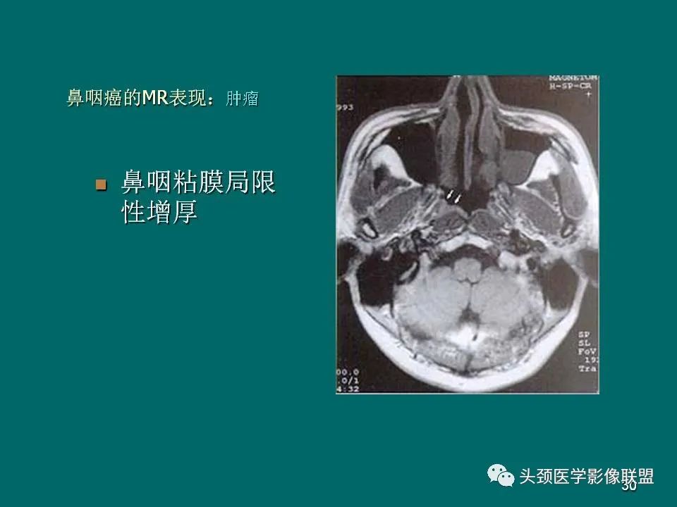 影像PPT - 【PPT】鼻咽癌的MRI诊断-30