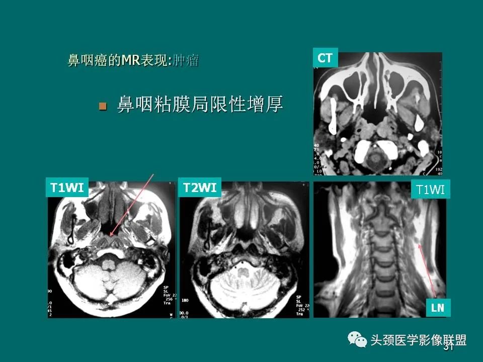影像PPT - 【PPT】鼻咽癌的MRI诊断-31