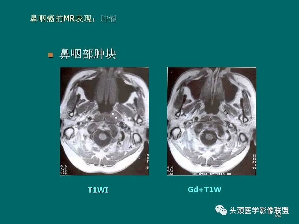 影像PPT - 【PPT】鼻咽癌的MRI诊断-32