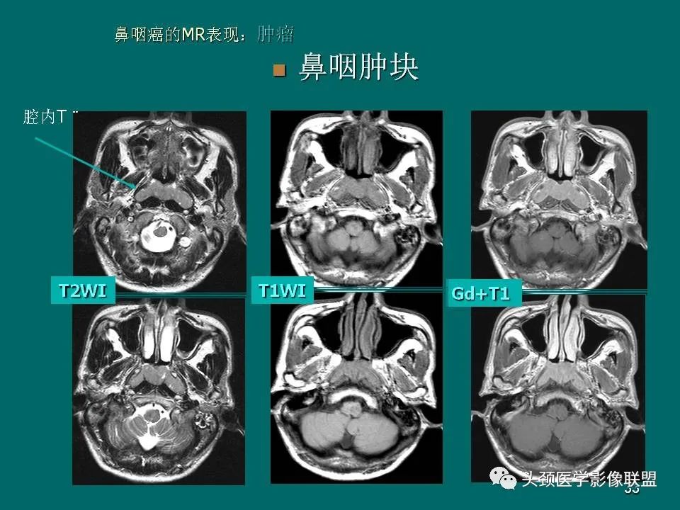 影像PPT - 【PPT】鼻咽癌的MRI诊断-33