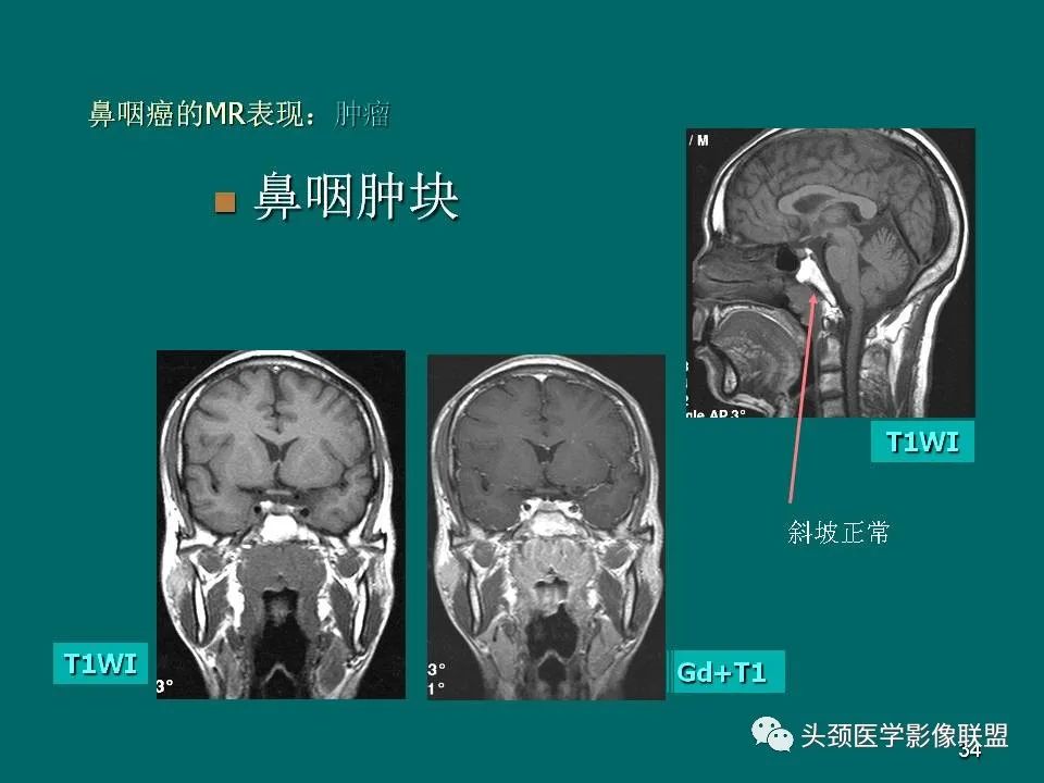 影像PPT - 【PPT】鼻咽癌的MRI诊断-34