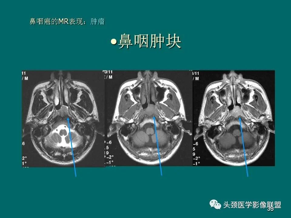 影像PPT - 【PPT】鼻咽癌的MRI诊断-35