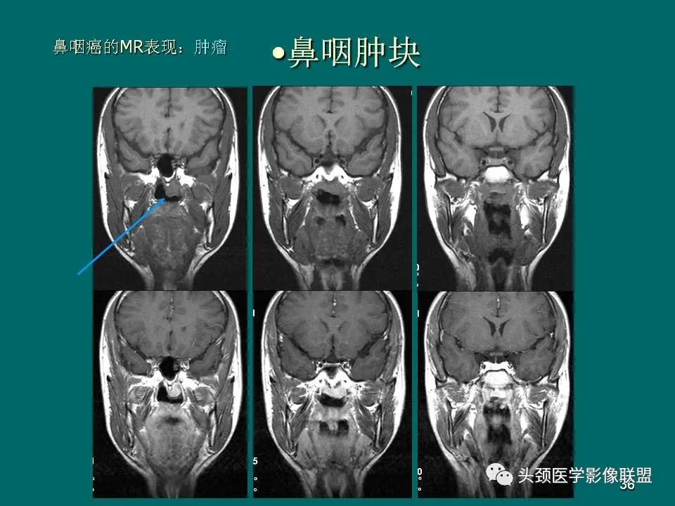 影像PPT - 【PPT】鼻咽癌的MRI诊断-36