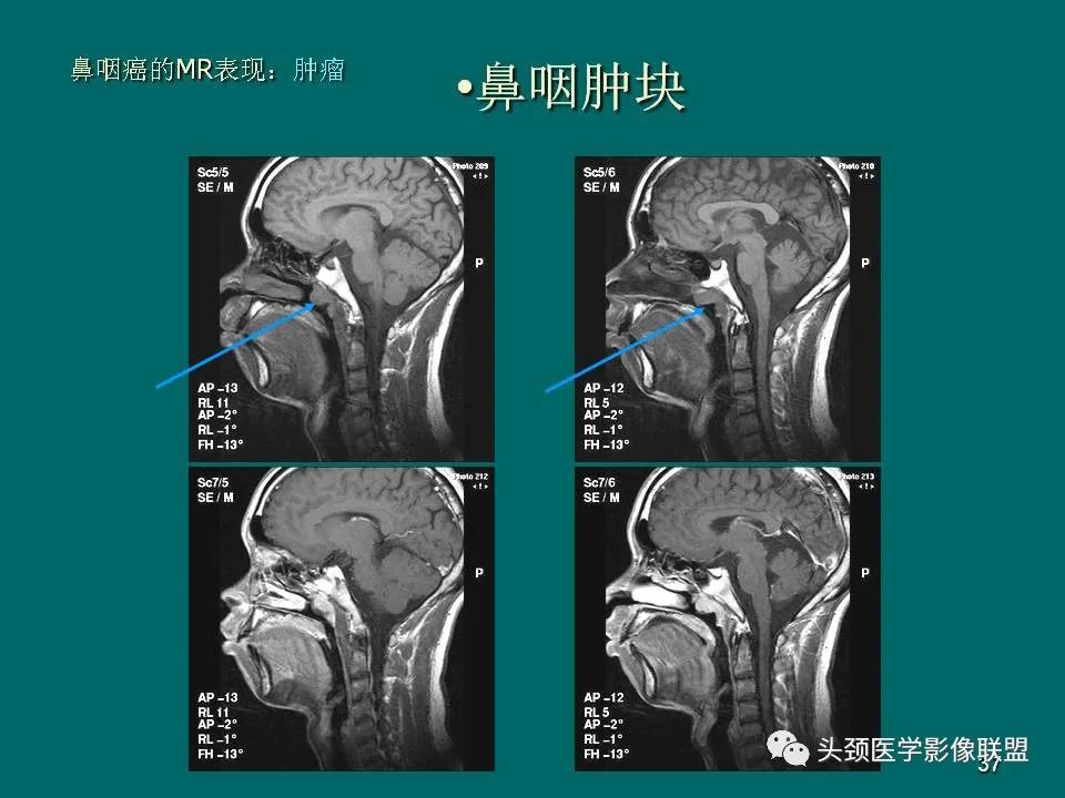 影像PPT - 【PPT】鼻咽癌的MRI诊断-37