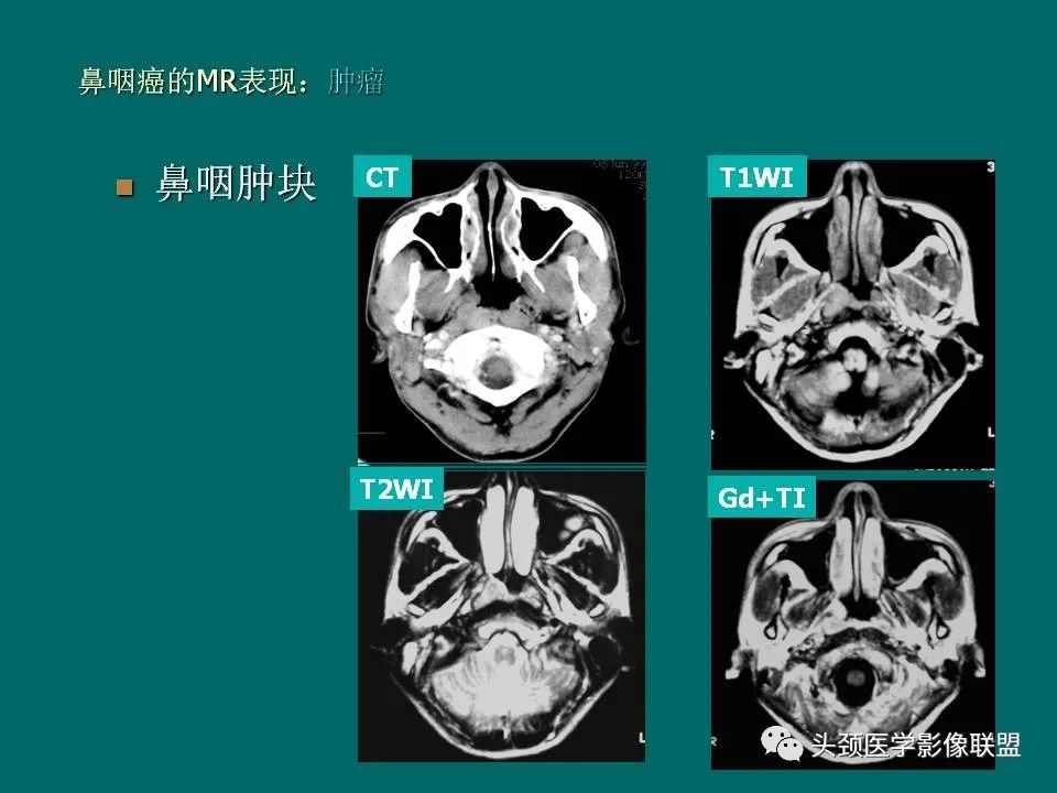 影像PPT - 【PPT】鼻咽癌的MRI诊断-38