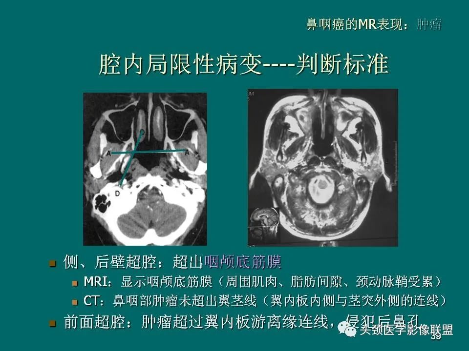 影像PPT - 【PPT】鼻咽癌的MRI诊断-39