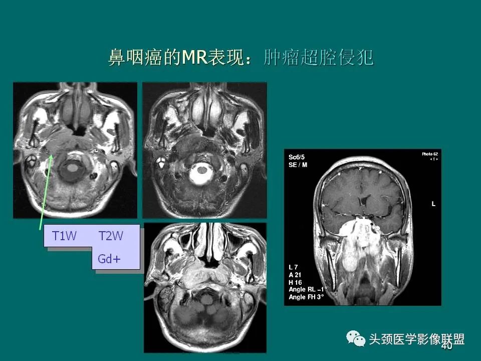 影像PPT - 【PPT】鼻咽癌的MRI诊断-40