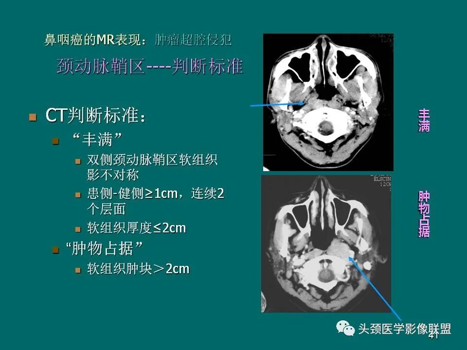 影像PPT - 【PPT】鼻咽癌的MRI诊断-41
