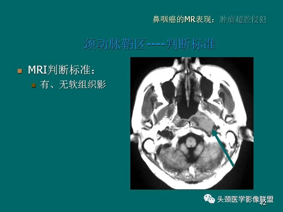 影像PPT - 【PPT】鼻咽癌的MRI诊断-42
