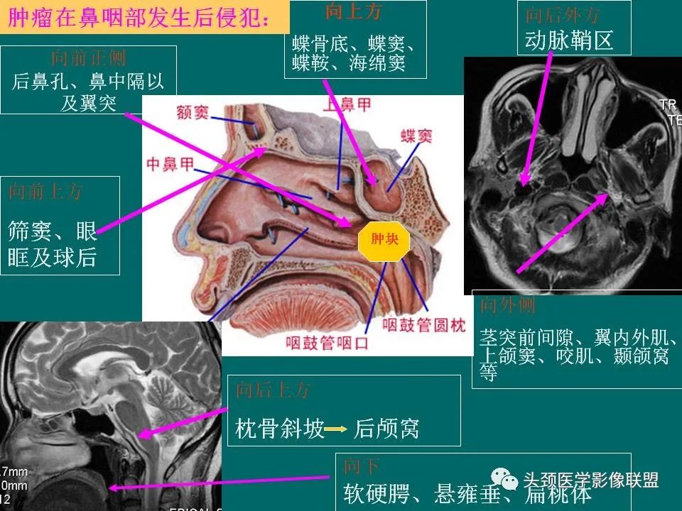 影像PPT - 【PPT】鼻咽癌的MRI诊断-45