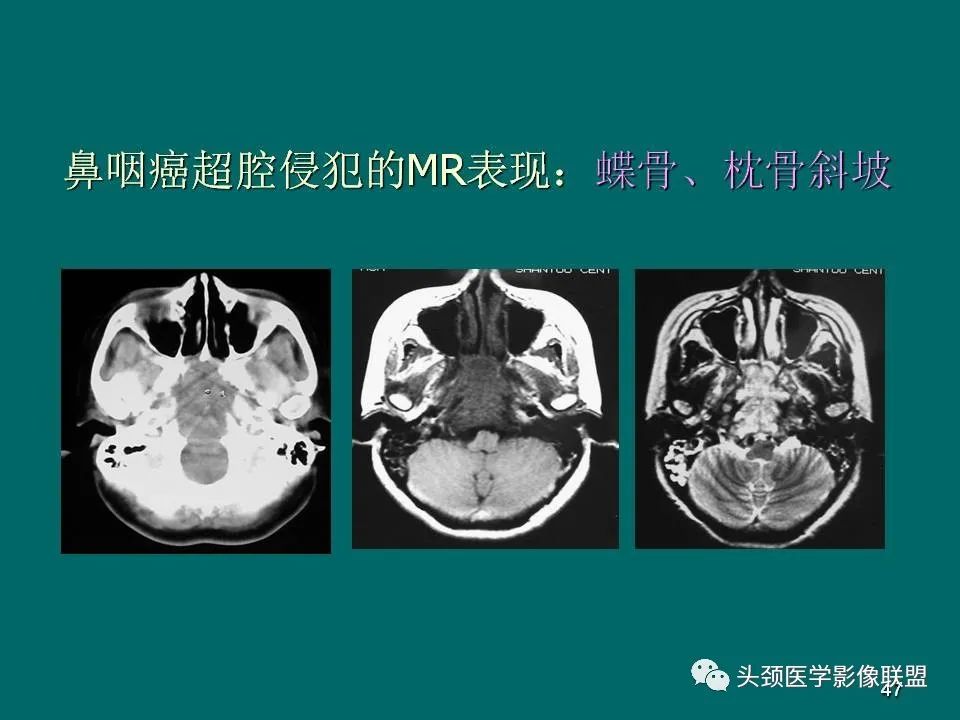 影像PPT - 【PPT】鼻咽癌的MRI诊断-47
