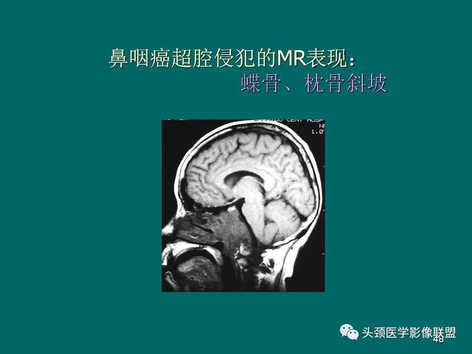 影像PPT - 【PPT】鼻咽癌的MRI诊断-48