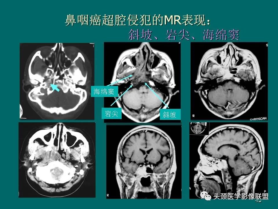 影像PPT - 【PPT】鼻咽癌的MRI诊断-49