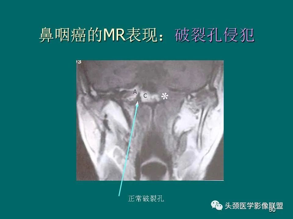 影像PPT - 【PPT】鼻咽癌的MRI诊断-50