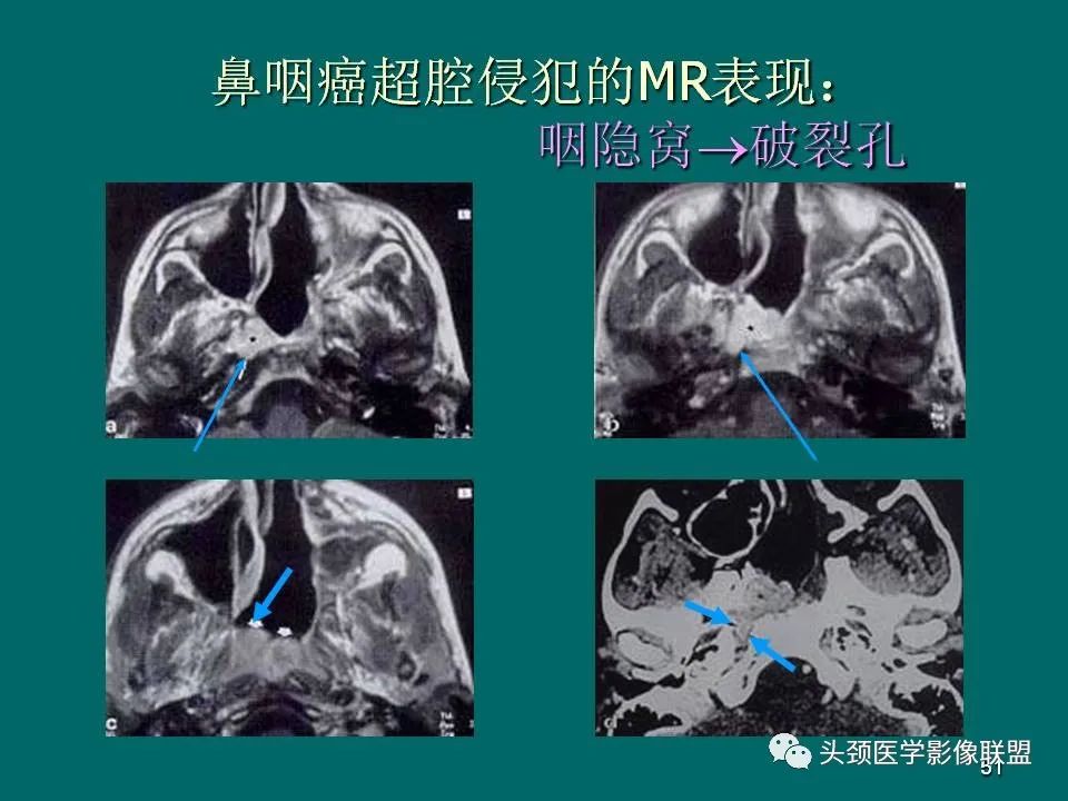 影像PPT - 【PPT】鼻咽癌的MRI诊断-51