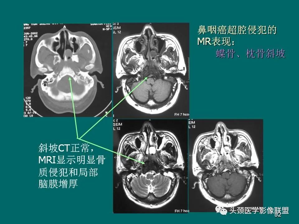 影像PPT - 【PPT】鼻咽癌的MRI诊断-52