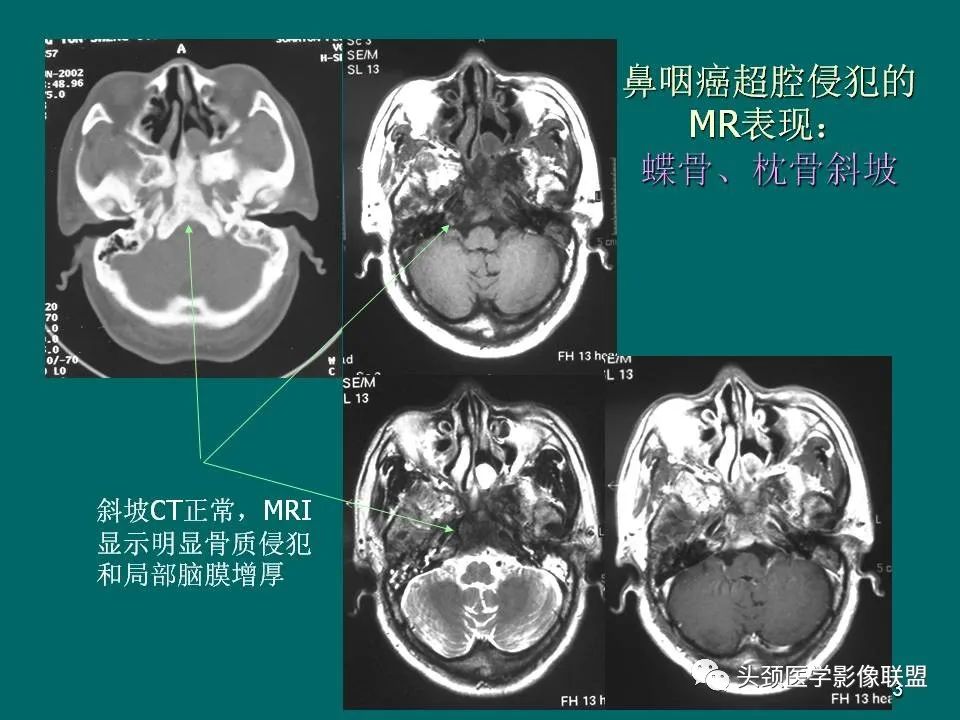影像PPT - 【PPT】鼻咽癌的MRI诊断-53