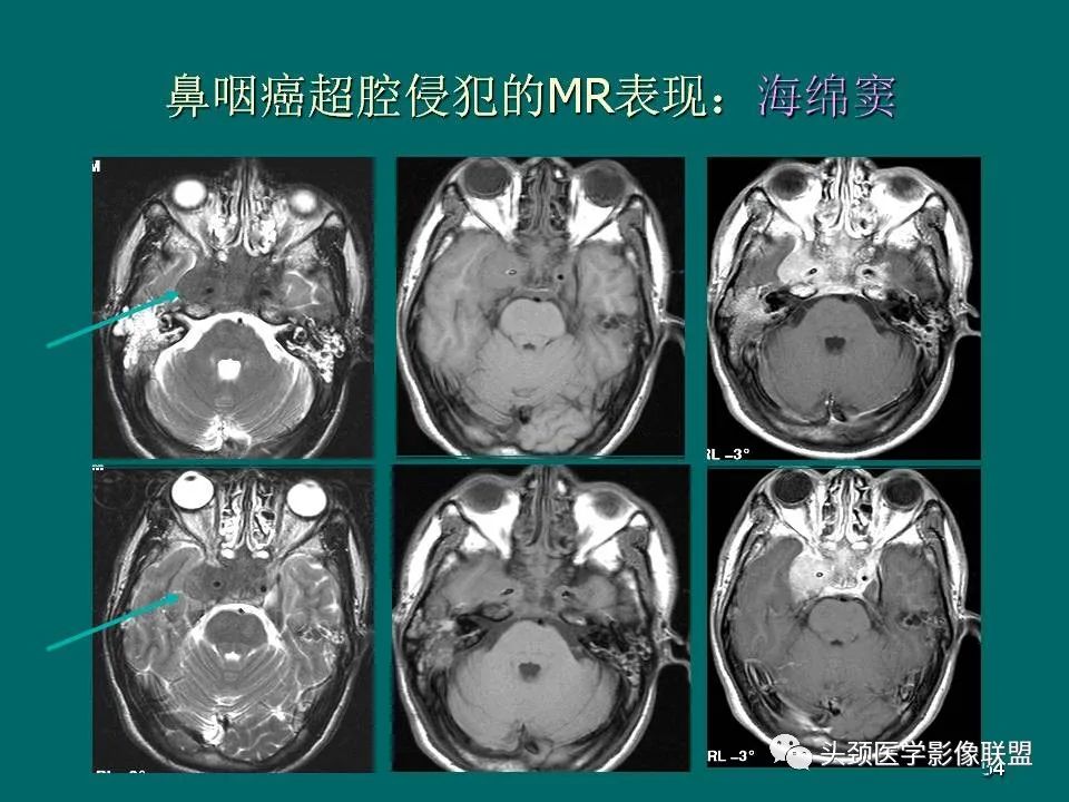 影像PPT - 【PPT】鼻咽癌的MRI诊断-54