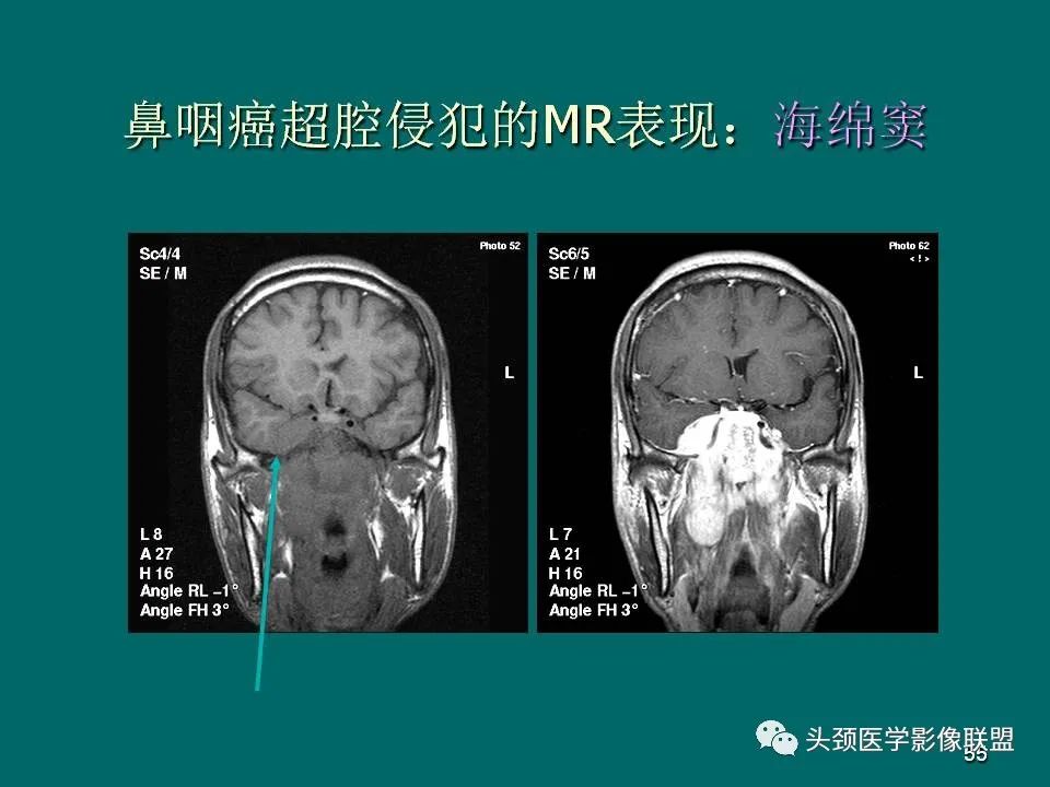 影像PPT - 【PPT】鼻咽癌的MRI诊断-55