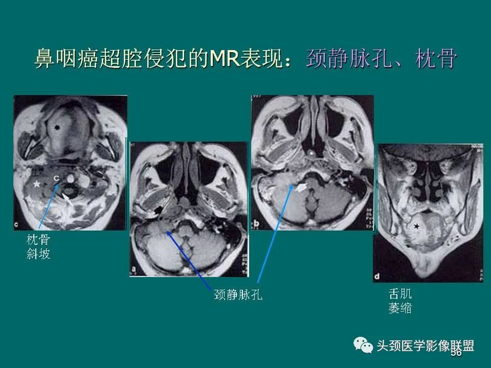影像PPT - 【PPT】鼻咽癌的MRI诊断-56