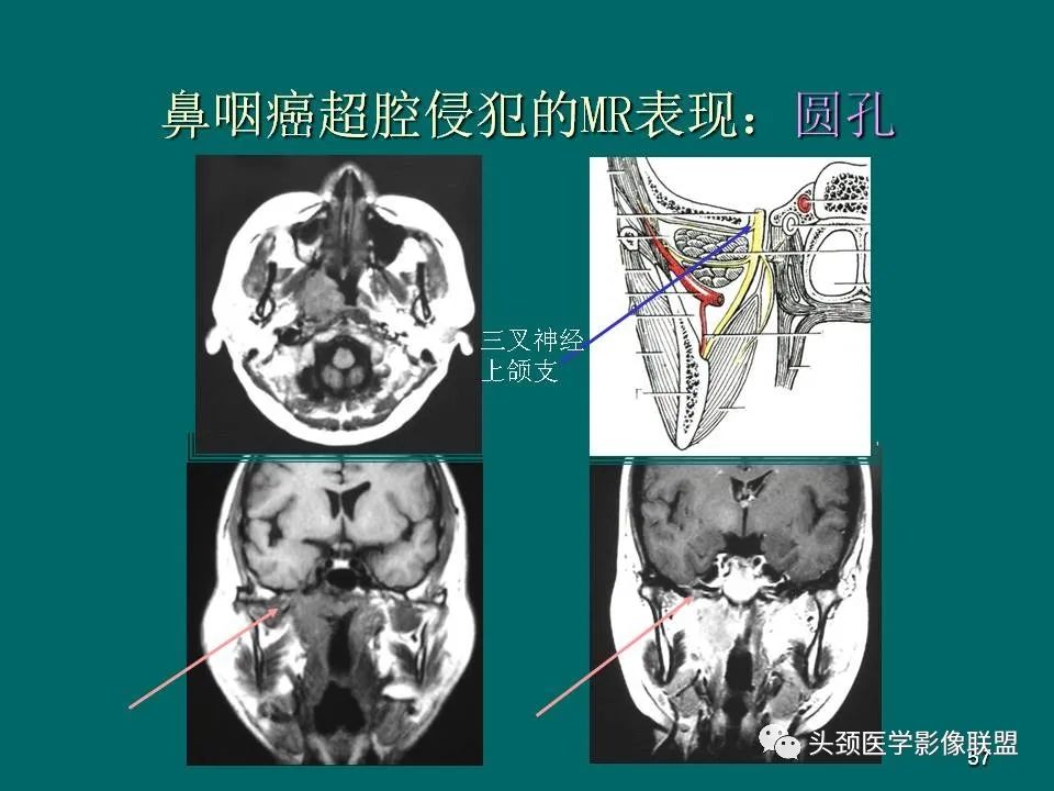 影像PPT - 【PPT】鼻咽癌的MRI诊断-57
