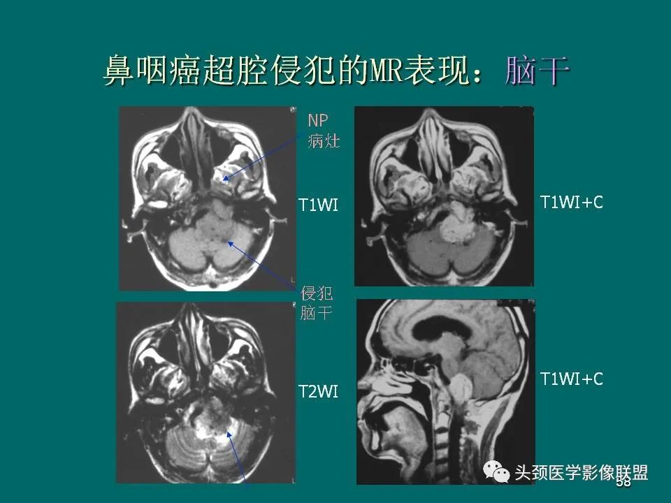 影像PPT - 【PPT】鼻咽癌的MRI诊断-58
