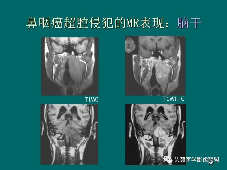 影像PPT - 【PPT】鼻咽癌的MRI诊断-59