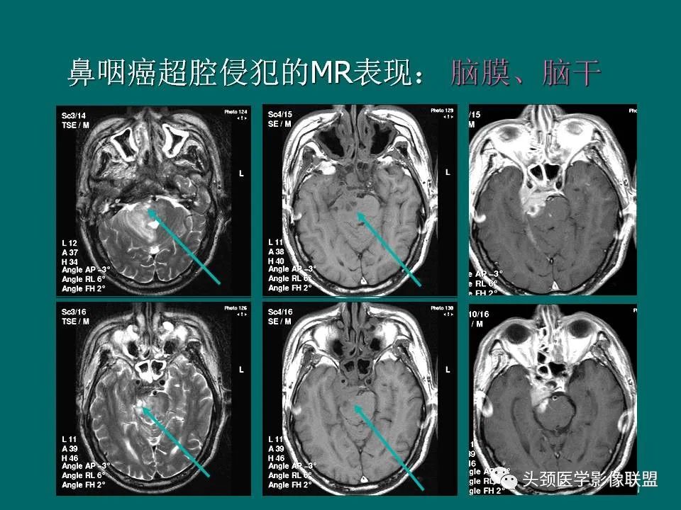 影像PPT - 【PPT】鼻咽癌的MRI诊断-60