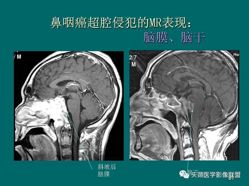 影像PPT - 【PPT】鼻咽癌的MRI诊断-61