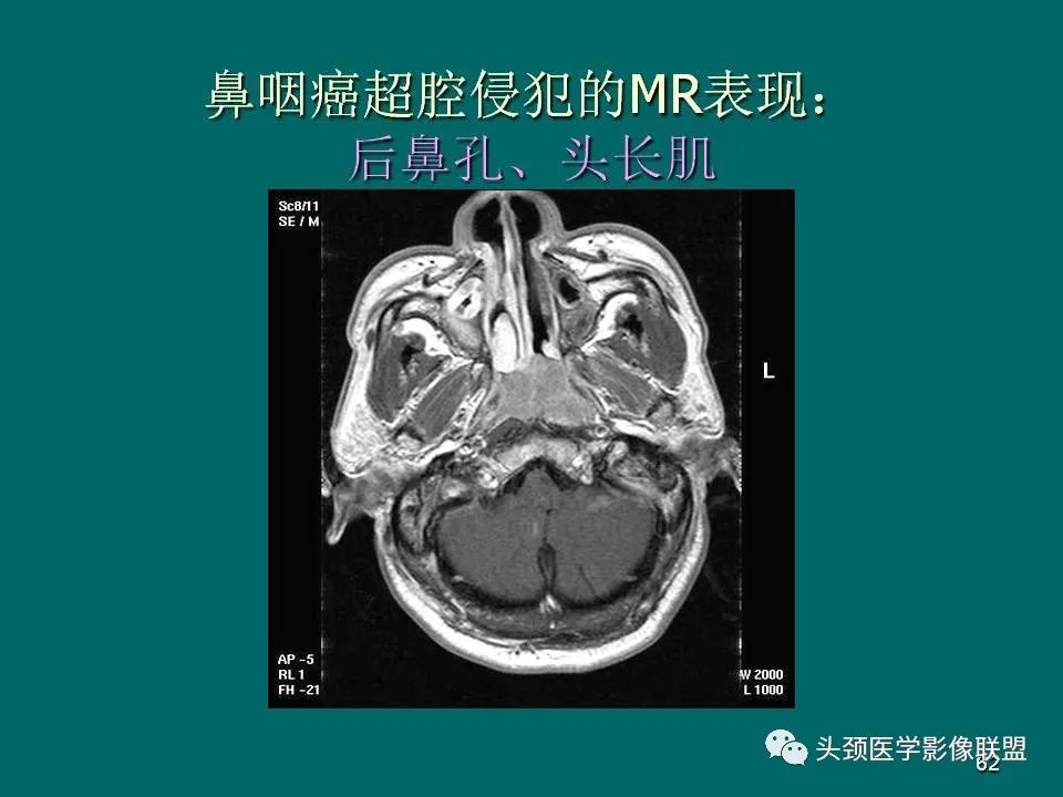 影像PPT - 【PPT】鼻咽癌的MRI诊断-62