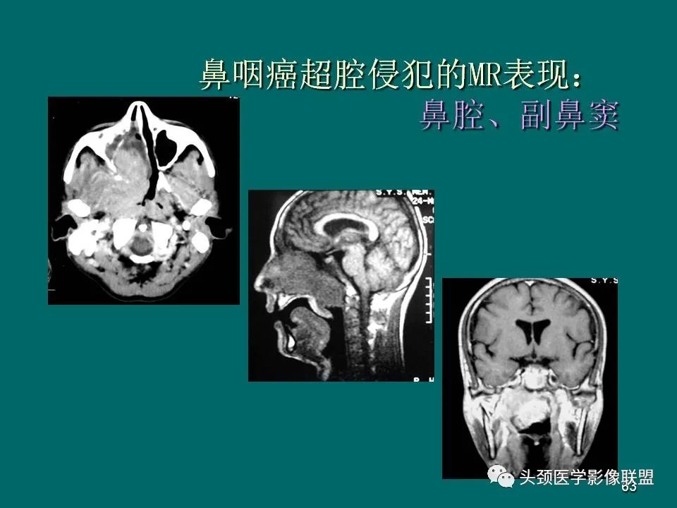 影像PPT - 【PPT】鼻咽癌的MRI诊断-63
