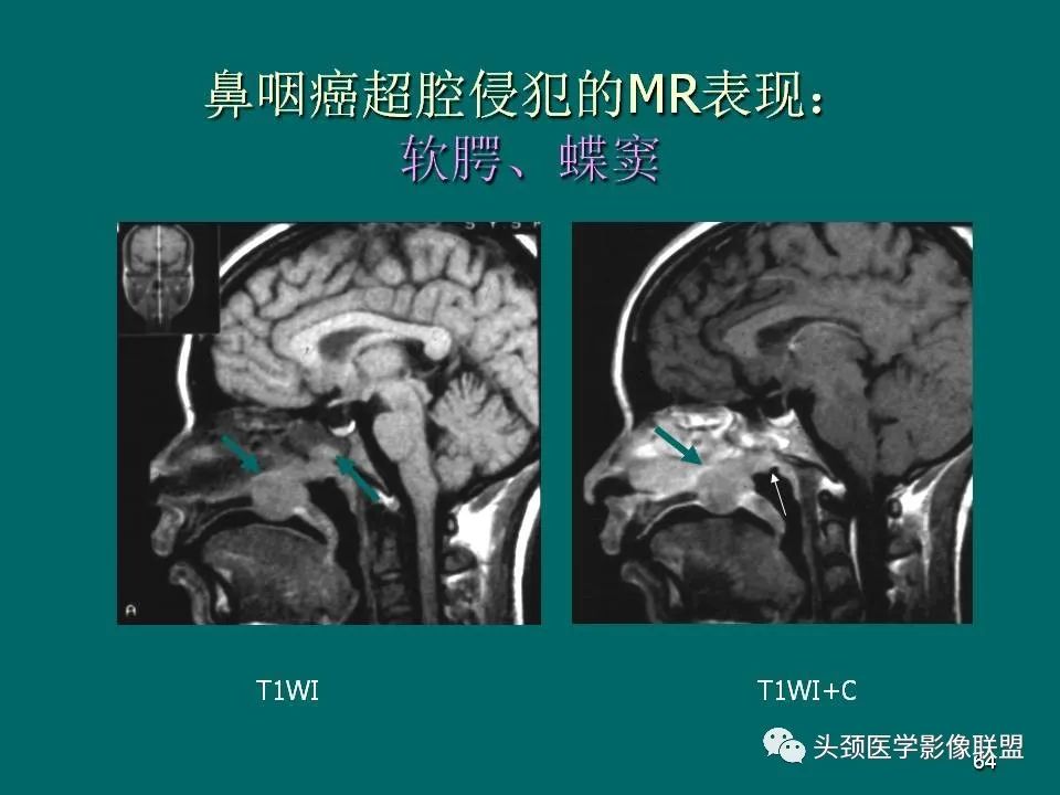 影像PPT - 【PPT】鼻咽癌的MRI诊断-64