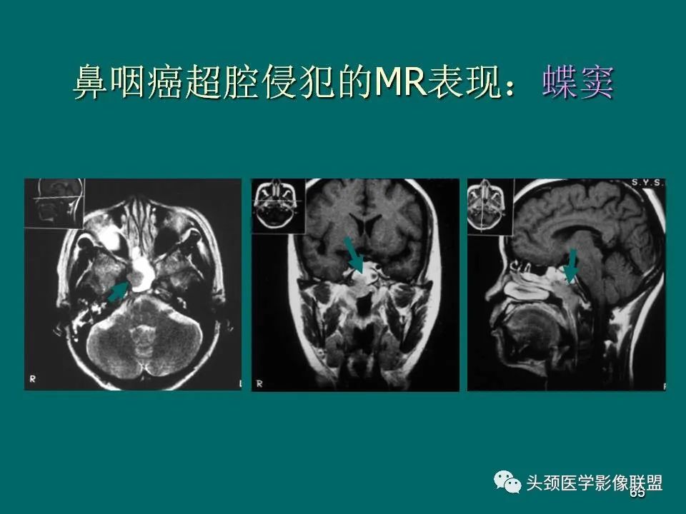 影像PPT - 【PPT】鼻咽癌的MRI诊断-65