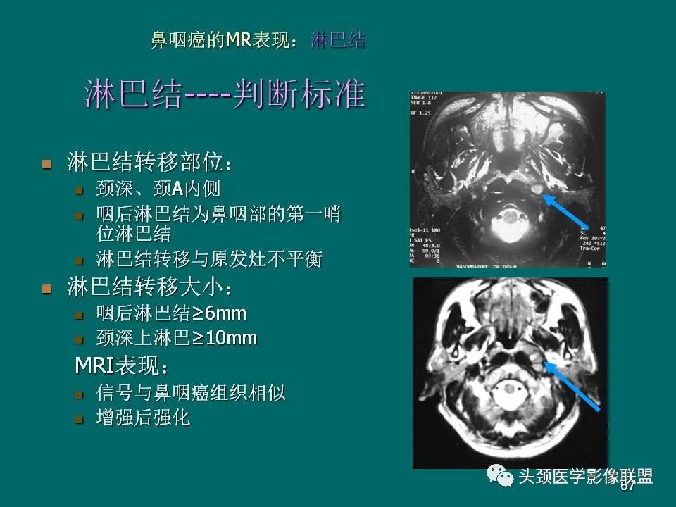 影像PPT - 【PPT】鼻咽癌的MRI诊断-67