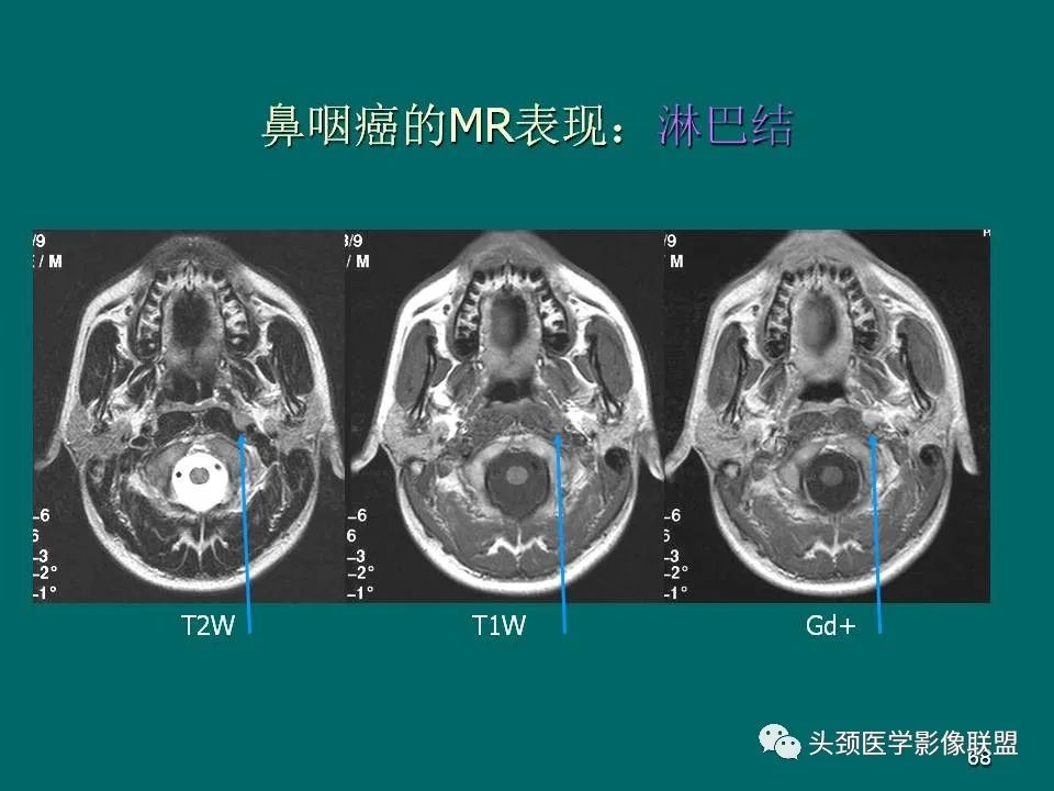 影像PPT - 【PPT】鼻咽癌的MRI诊断-68