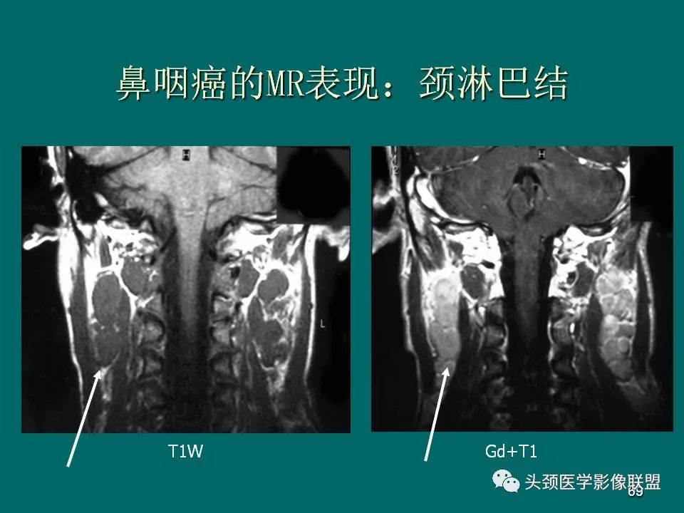 影像PPT - 【PPT】鼻咽癌的MRI诊断-69
