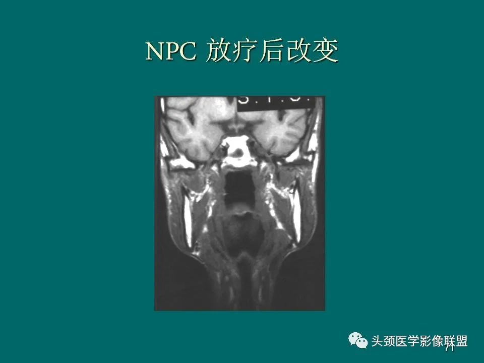 影像PPT - 【PPT】鼻咽癌的MRI诊断-71