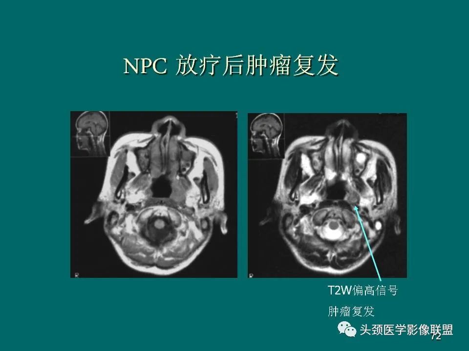 影像PPT - 【PPT】鼻咽癌的MRI诊断-72