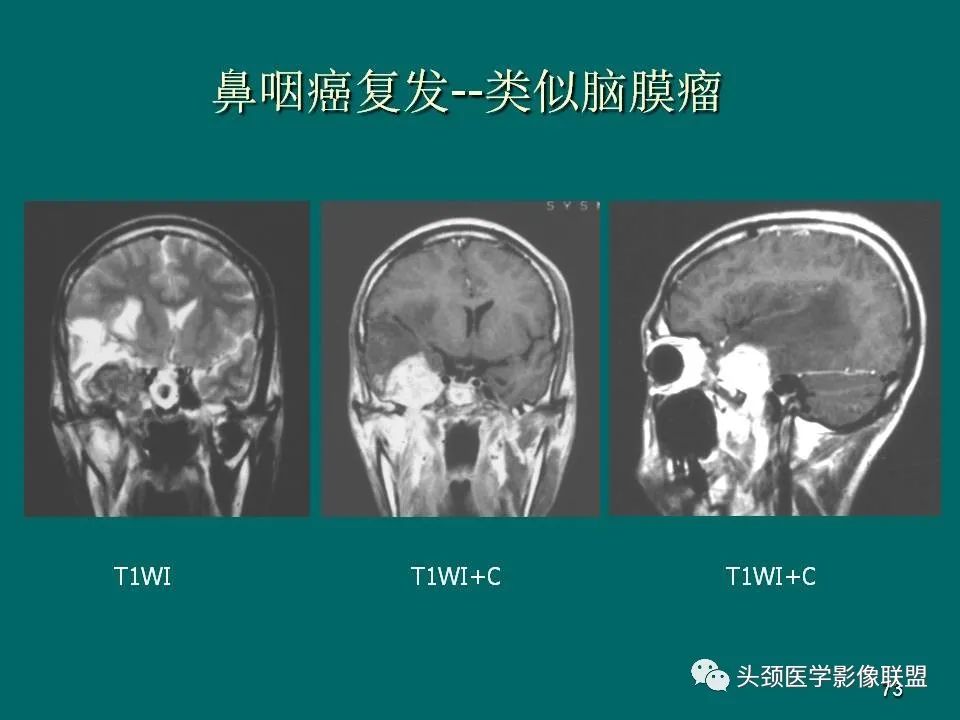 影像PPT - 【PPT】鼻咽癌的MRI诊断-73