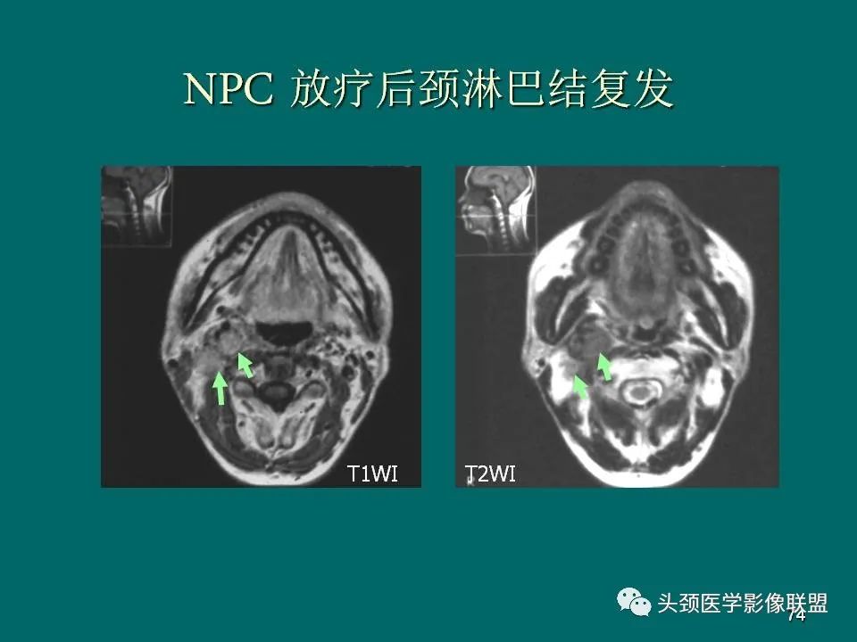 影像PPT - 【PPT】鼻咽癌的MRI诊断-74