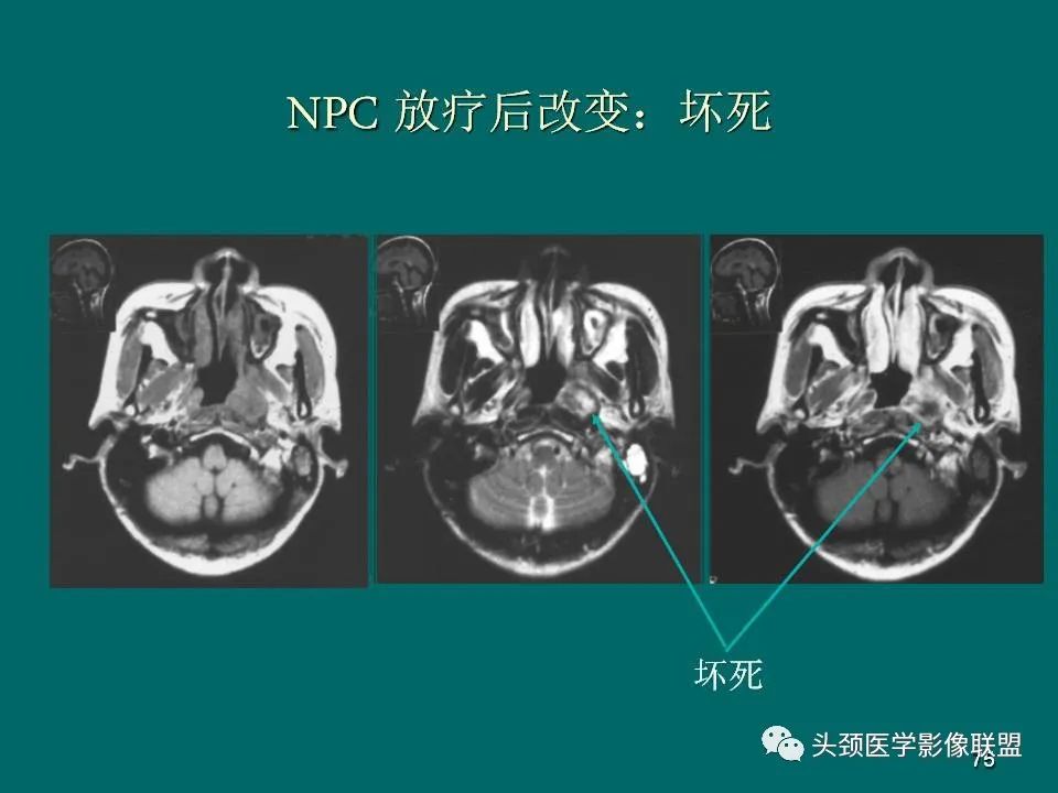 影像PPT - 【PPT】鼻咽癌的MRI诊断-75