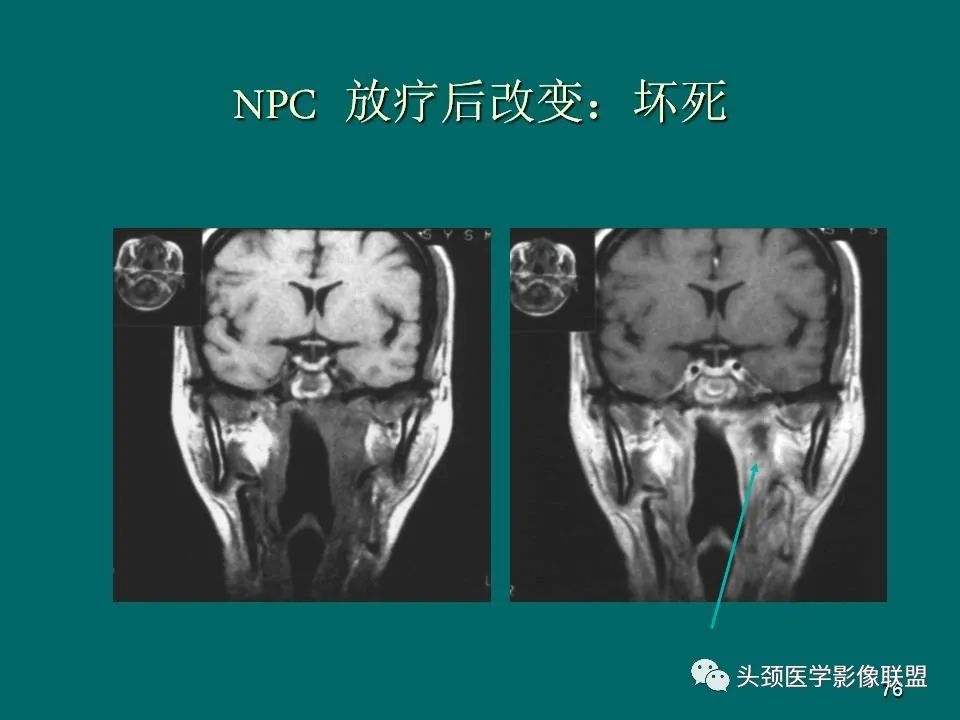 影像PPT - 【PPT】鼻咽癌的MRI诊断-76