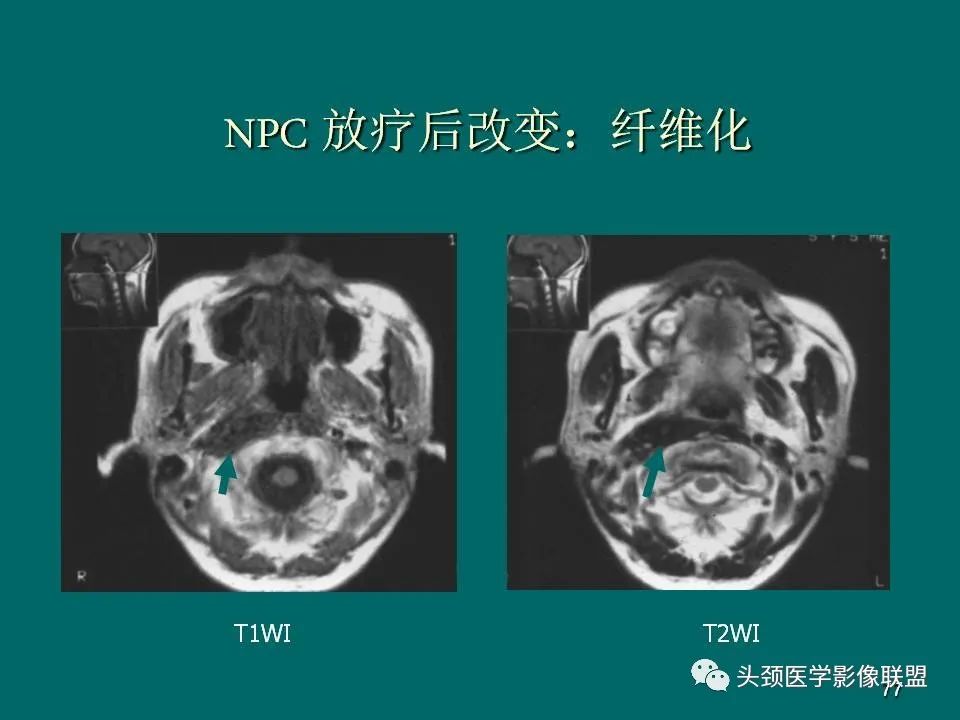 影像PPT - 【PPT】鼻咽癌的MRI诊断-77