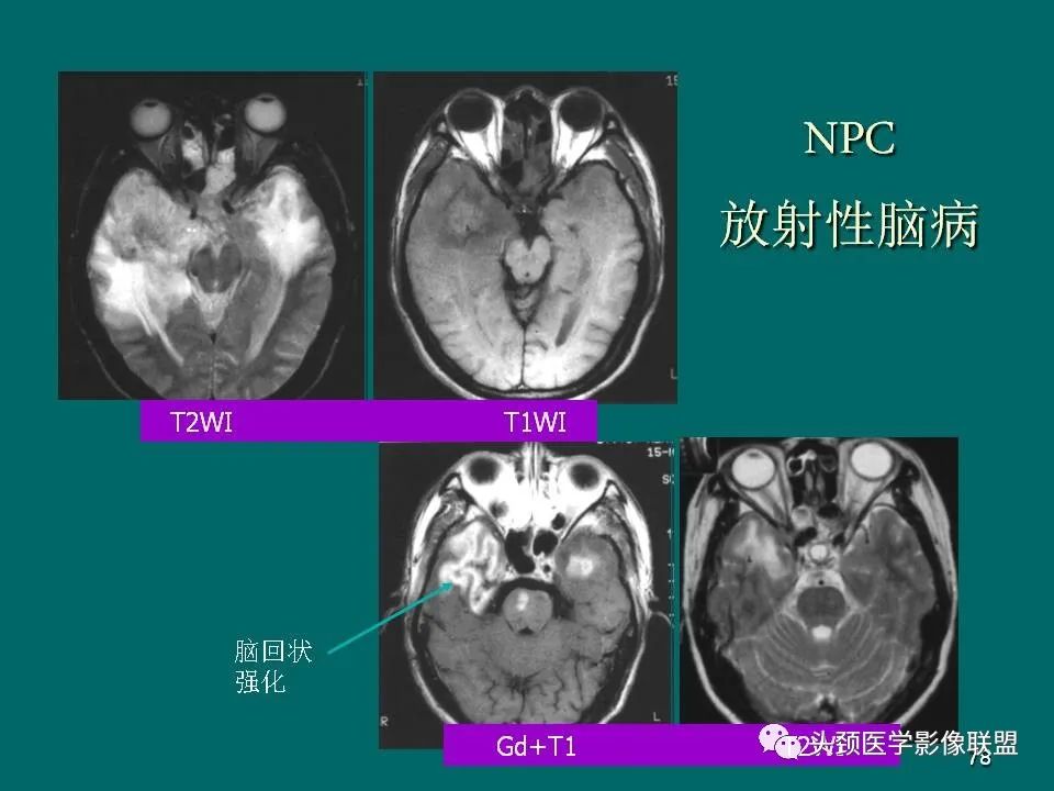 影像PPT - 【PPT】鼻咽癌的MRI诊断-78